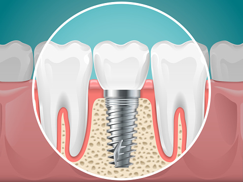 Wilsonville Dental Group - Benefits and Risks of Dental Implants
