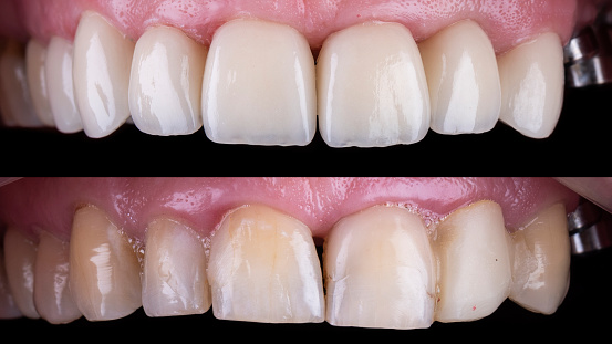 Wilsonville Dental Group - Veneers