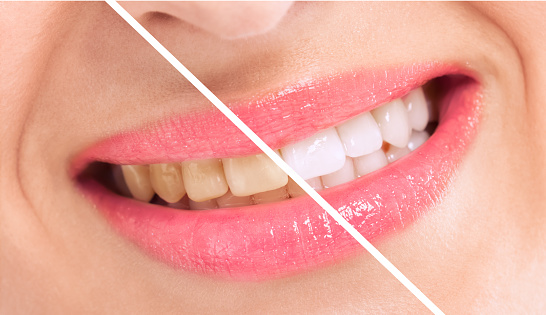 Wilsonville Dental Group - Teeth Whitening