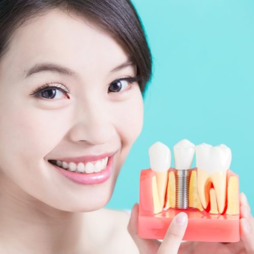 Wilsonville Dental Group - Dental Implants