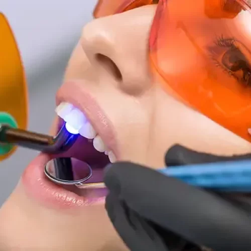 A dentist applying a curing light during a dental bonding procedure while the patient wears protective orange glasses.