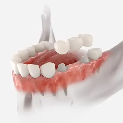 A transparent view of a jaw where a bridge is being placed over two teeth and the gap between them.