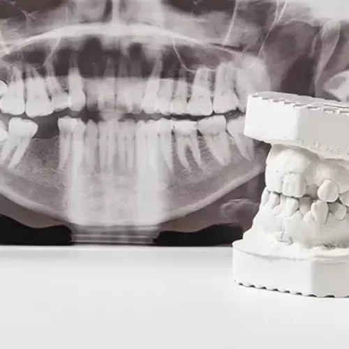 A dental model placed next to a panoramic X-ray, illustrating full-mouth restoration planning.